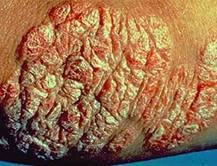 Psoriasis naturopath Perth | psoriasis homeopath Perth